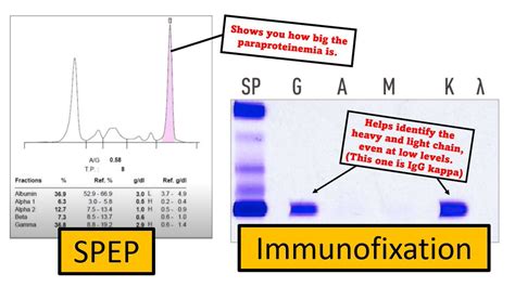 1/ We often check SPEP and/or immunofixation in patients with