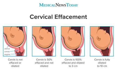 As labor begins, the cervix starts to soften, s