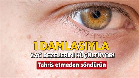 1 damlasıyla yağ bezelerine kökten çözüm! Tahriş  Milliyet.