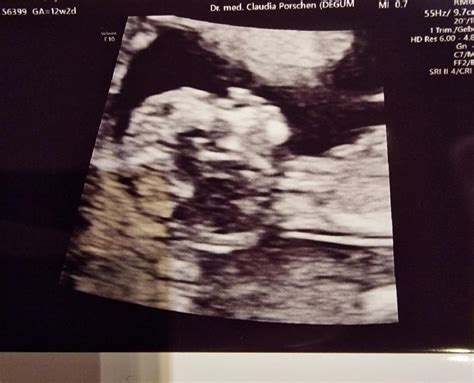 1. fa termin schwangerschaft