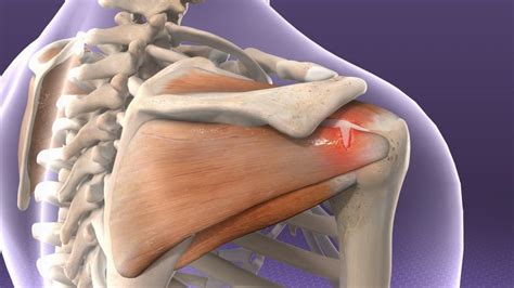 10 Cigna sports medicine specialists for rotator cuff injury in ...