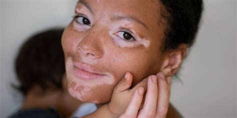 10 Cara Menghilangkan Vitiligo Pada Kulit Klikdokter Cara Mengatasi Vitiligo - Cara Mengatasi Vitiligo
