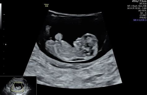 10 week ultrasound.  Forum: Windows 10 Forums Sub-Forums Threads / Post...
