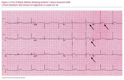 103 Prevalence And Significance Of Anterior T Wave Inversion In