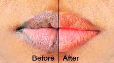 11 Simple Home Remedies for Dark Lips: Fight Lip Pigmentation Naturally