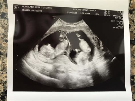 12 Weeks Pregnant with Twins: Ultrasound, Symptoms, …