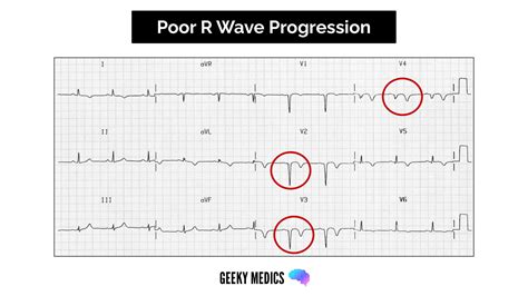12 lead ecg interpretation ppt.  Poor R- wave progression can indicate LB...