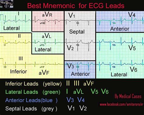 12 Lead Ekg Interpretation Cheat Sheet