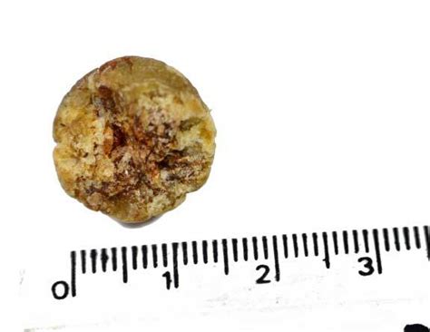 12 mm Kidney Stone Treatment