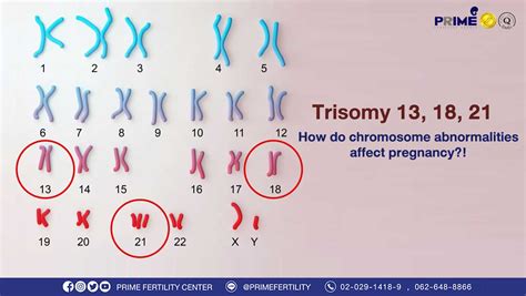 13 kromozom trizomisi