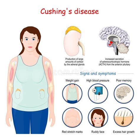 15 Signs of Cushings Syndrome Never to Ignore 5 Minute Read