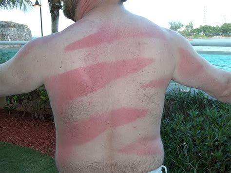 15 Sunburn Fails That Will Make You Question Humanity