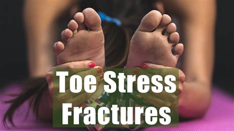 157 Toe Stress Fractures From Running Doc Bone Fractures Worksheet Answers - Bone Fractures Worksheet Answers
