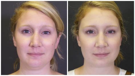 19 Facts About Chin and Facial Liposuction - Zwivel