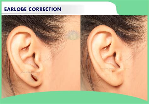 190 Best Ear Lobe Correction Repair Doctors In Chennai - Practo