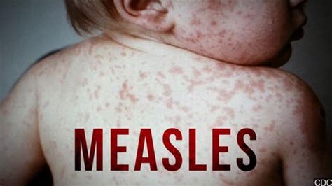 1st measles case reported in Maine since 2019