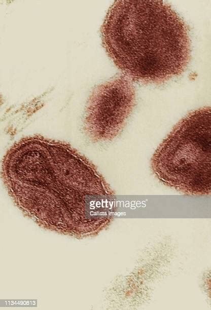 2,030 Images Of Smallpox Premium High Res Photos