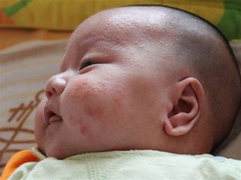 2个月的孩子脸上有一片片红点是怎么回事