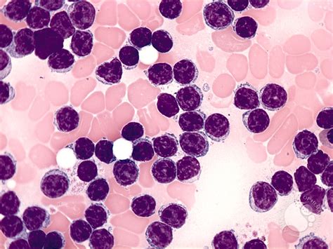 2 Chronic Lymphocytic Leukemias