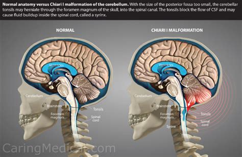 2 Mm Cerebellar Tonsillar Ectopia Symptoms