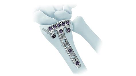 2.4mm Variable Angle LCP® Volar Rim Distal Radius System to