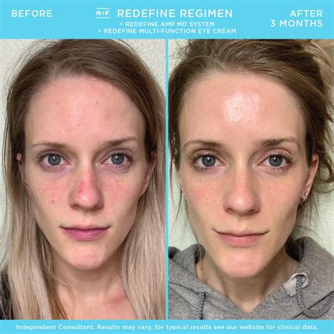 20 Rodan and Fields Before and After Pictures That Will …