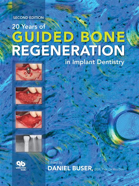 20 Years Of Guided Bone Regeneration In Implant De