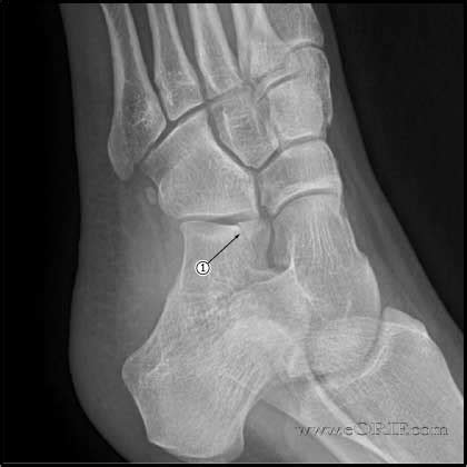 2012 ICD-9-CM Diagnosis Code 825.0 : Fracture of calcaneus, closed