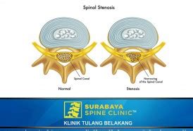 2013 02 16 Surabaya Lumbar Spinal Stenosis