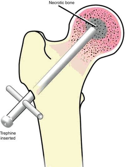 2014 HCPCS S2325 : Hip core decompression - ICD-9 Data.com