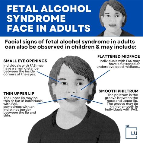 Fetal alcohol syndrome images adults