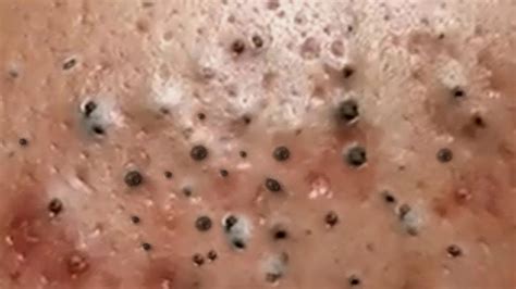 Worst of the worst gigantic blackheads, new cyst removal videos, ne
