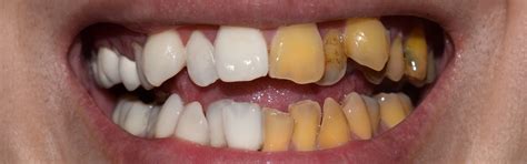 2024 Zahnverfärbung durch antibiotika entfernen