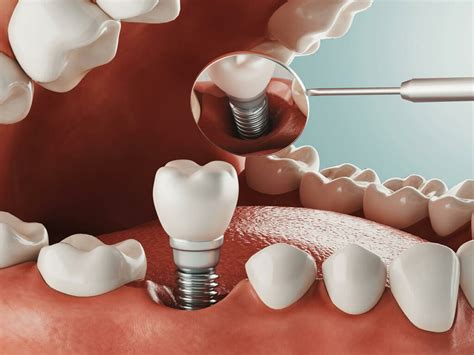 $1200 dental implants las vegas Welcome to Family & Implant Dentistry! We offer full dental services to take care of you and your whole family