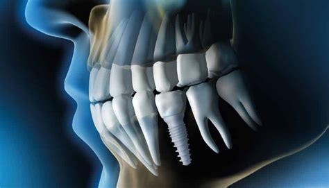 $1200 dental implants las vegas  Specialties: Radiant Smiles has one mission : make your smile shine like the sun ! This General and cosmetic dentistry clinic will take care of all the family