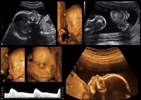 4d pregnancy scan Patient : Saya nak buat 4D scan jer, 3D tak nak