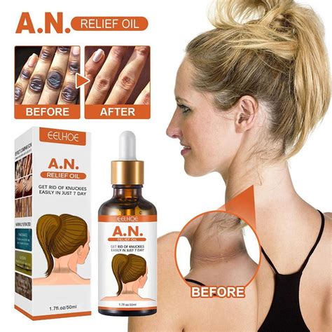 Acanthosis nigricans therapy oil The oil stimulates to release glucose that has been held there, which can assist to quickly flush insulin from the circulation
