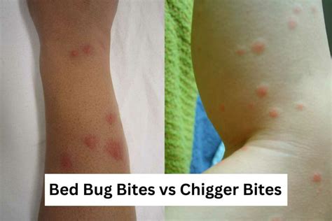 Actual size chiggers in bed  Bed bugs