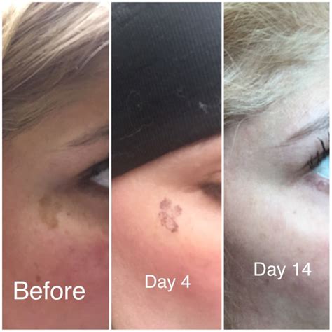Age spot removal charleston  We use a variety of laser devices to fade spots including the Cynosure Apogee Elite