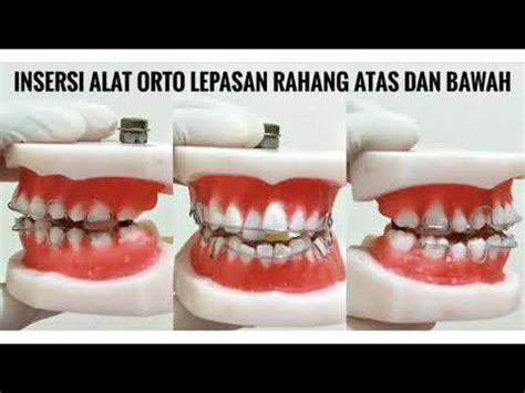 Alat ortho lepasan <b>kkd ,noscaasI( rasad iagabes kilirka nad leets sselniats tawak halada nasapel kitnodotro tala malad amatu takgnareP </b>