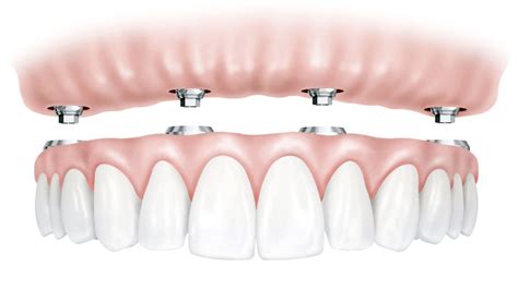 All on 4 dental implants mill valley, ca <b>ni desu stnalpmi latned ehT </b>