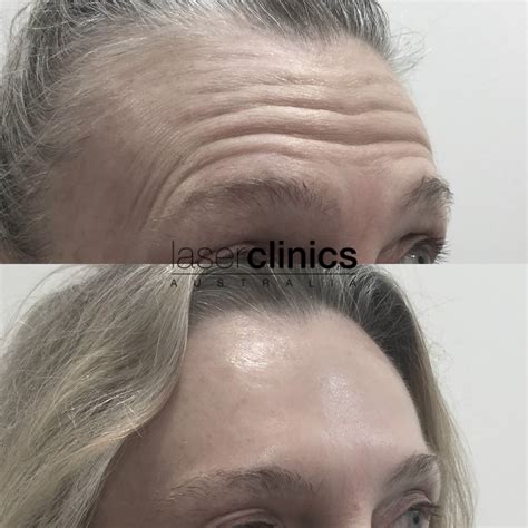 Anti wrinkle injections helensvale  The result is a more youthful appearance, with firm and smoother skin