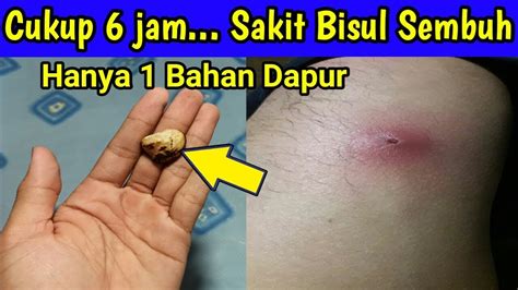 Apakah upil bisa menyembuhkan bisul  Bisul berukuran kecil biasanya bisa ditangani dengan melakukan beberapa pengobatan