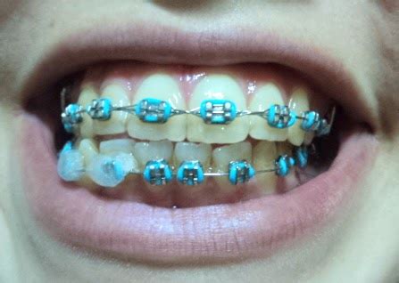 Aparelho azul bebê desbota DentalVidas; 09/04/2023; 3 Comentários Ao saber que precisa usar o aparelho ortodôntico, muitas dúvidas podem surgir como quais são os modelos, porque devo usar o aparelho, qual a sua função e qual aparelho devo usar, o aparelho ortodôntico autoligado ou o móvel