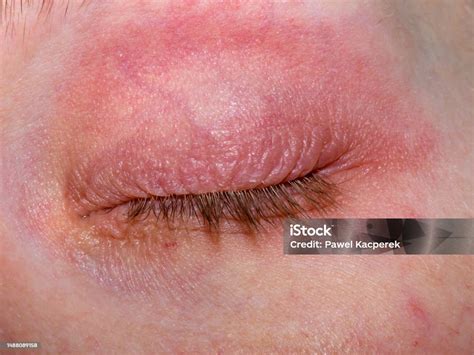 Atopic dermatitis eyelid icd 10 11