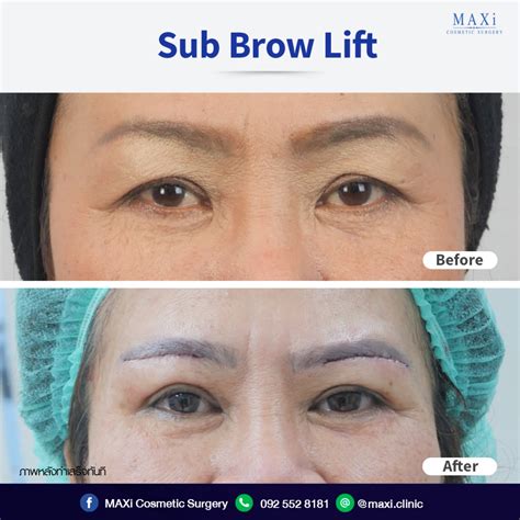 Awi brow lift  and now I would also like a brow lift 😅 we have similar eyes and I thought I needed an upper blepharoplasty