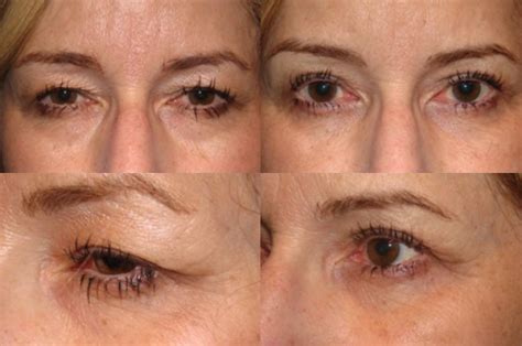 Awi brow lift  The Claims: Applying anti-aging creams to the eye area and above the eyebrow can lift, tighten and firm the skin