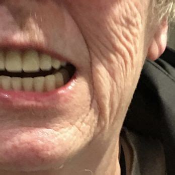 Bellingham denture repair  See reviews, photos, directions, phone numbers and more for Sunset Dental Center locations in Bellingham, WA