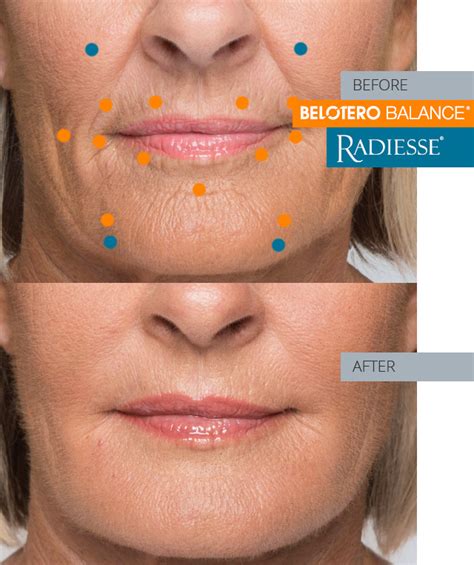 Belotero asheboro  Belotero Soft dermal filler gives an extremely effective result straight away following injection into the superficial layer of the skin dermis and continues to work over the