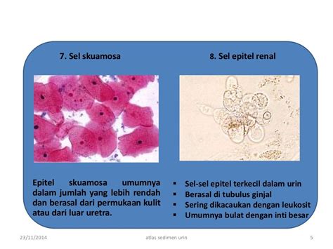 Benang mukosa pada urin  Infeksi saluran kemih